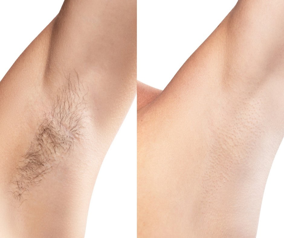 Silky smooth underarm hair removal after laser treatment at Luxe Laser Lounge & Boutique.