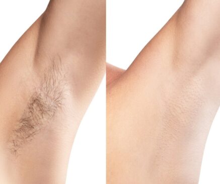 Silky smooth underarm hair removal after laser treatment at Luxe Laser Lounge & Boutique.