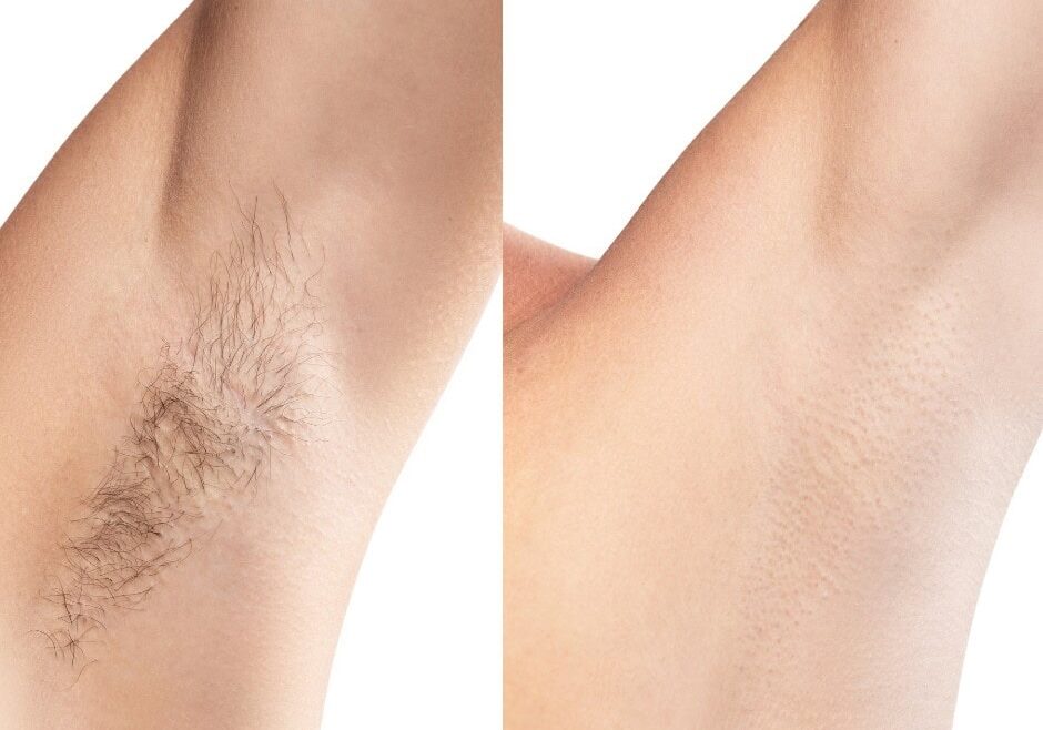 Luxe - Images Silky smooth underarm hair removal after laser treatment at Luxe Laser Lounge & Boutique.
